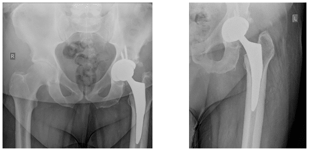 Case Study: A Caucasian Man With Hip Pain