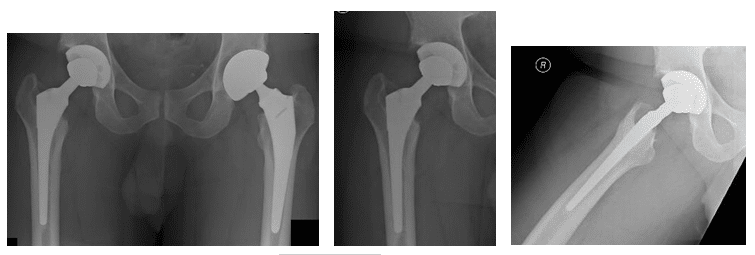 hip replacement 1