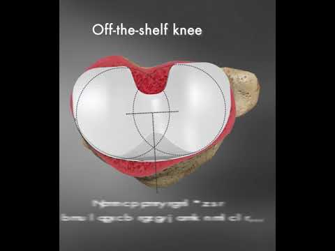 Vidéo sur la couverture rotationnelle et incorrecte des prothèses de genou standard