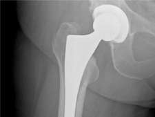 total hip replacement Xray