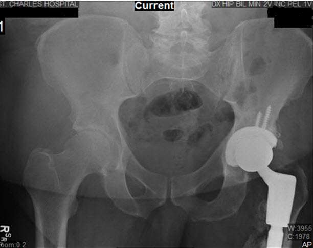 Removal of Spacer & Revision Left Hip