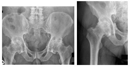 Étude de cas sur l’arthrite de la hanche et la bursite