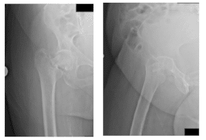 Partial Vs Total Hip Replacement [Why Total Is Better]