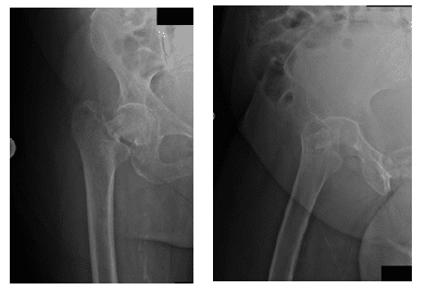 Arthroplastie de la hanche 1