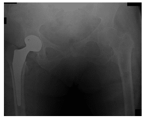 Arthroplastie de la hanche 2