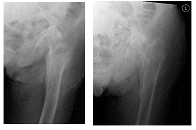 Étude de cas de matériel infecté avec reconstruction de la hanche à deux stades
