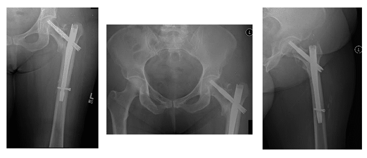 Case Study of Painful Hardware in Single Stage Hip Revision