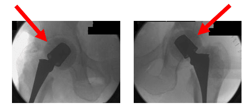 Bilateral Infection Native Hip with Arthritis