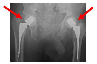 Native Hip with Arthritis 4