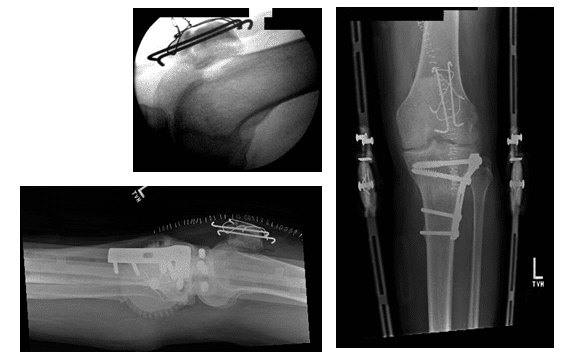 Case Study of Boney Non-Union Patella Fracture