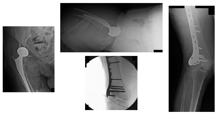 Periprosthetic Fracture 1