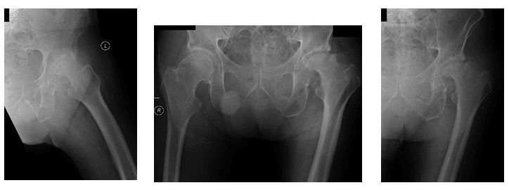 Étude de cas : Une arthroplastie totale de la hanche gauche à partir d’une arthroplastie totale de la hanche infectée