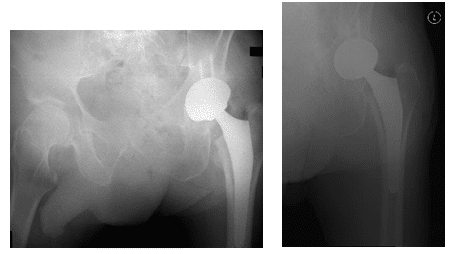 Arthroplastie totale de la hanche 2