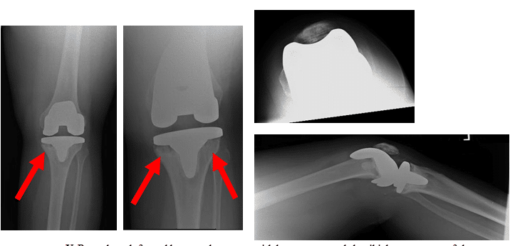Case Study of Loose Total Knee Replacement
