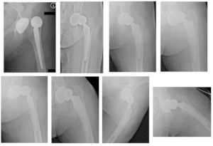 Recurrent Total Hip Arthroplasty Dislocation | Dr. Nakul