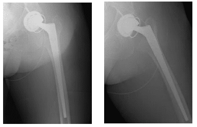 Case Study of Recurrent Total Hip Arthroplasty (THA) Dislocation with Constrained Liner