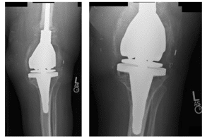 femoral and tibial 2