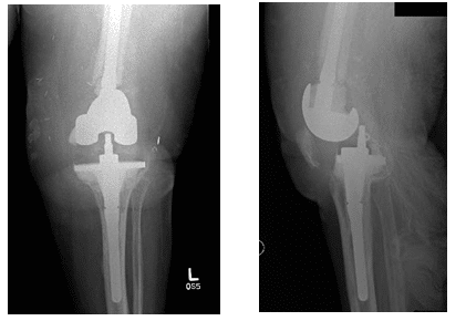 Limb Salvage Surgery Using Articulating Antibiotic Spacer | Dr. Nakul