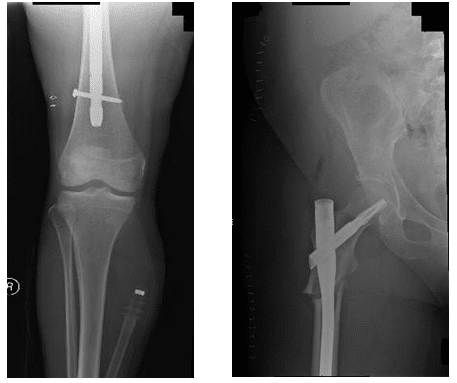 Case Study of Periprosthetic Fractures after Bisphosphonate Use