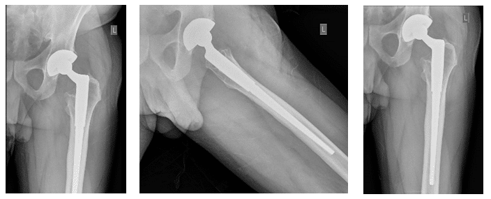 Étude de cas sur le relâchement de l’arthroplastie totale de la hanche gauche