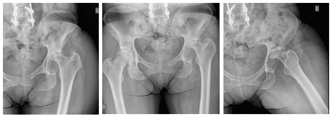 Case Study of Infective Native Hip