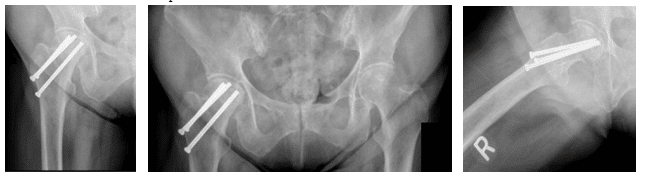 right hip fracture 1