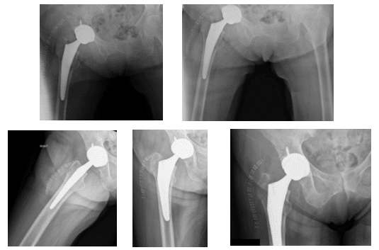 fracture de la hanche droite 2