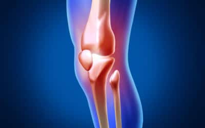 When Do You Need a Knee Replacement?