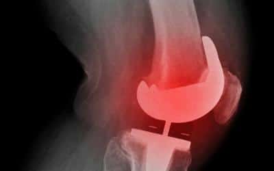 Prepare Yourself Better for Knee Replacement Revision Recovery