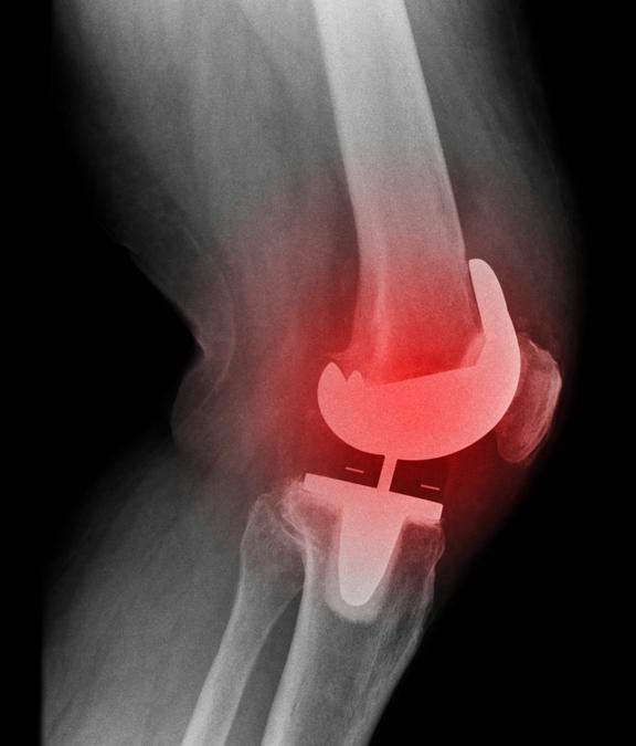 Prepárese mejor para la recuperación de la revisión de la prótesis de rodilla
