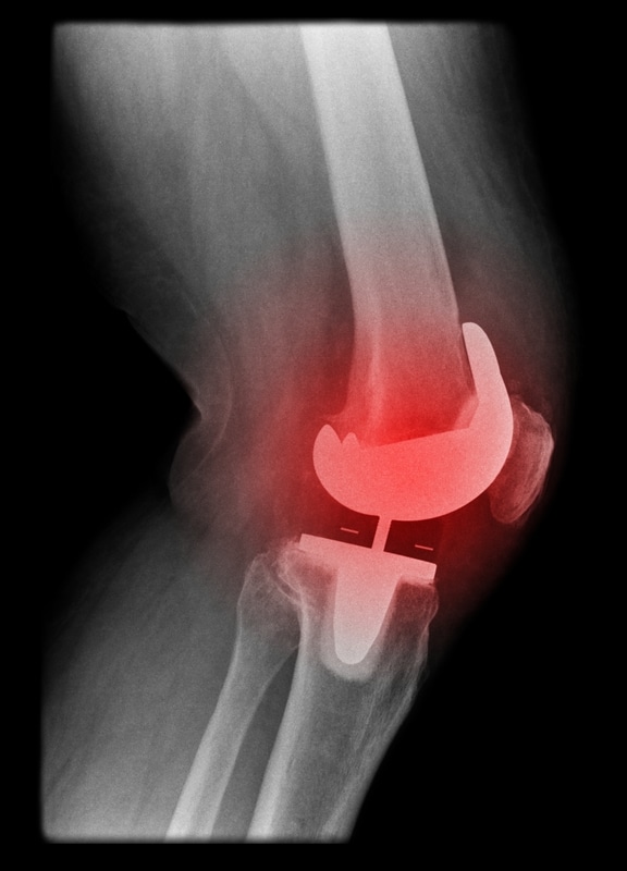 prótesis de rodilla dolorosa