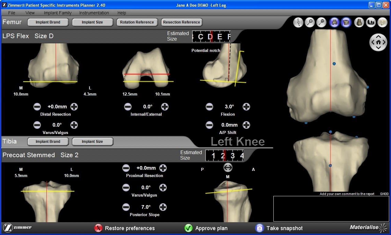 Knee measurements for an Implant