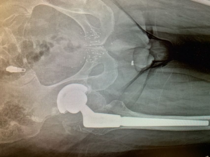 Case Study: JF – Revision Hip Replacement