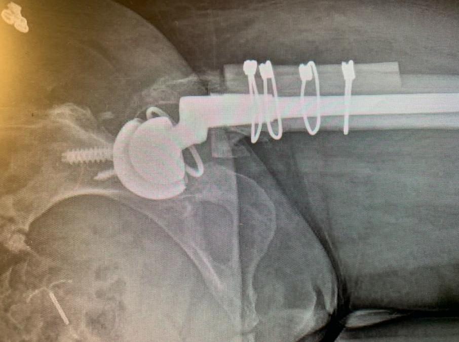 Estudio de caso: WM – Revisión de prótesis de cadera