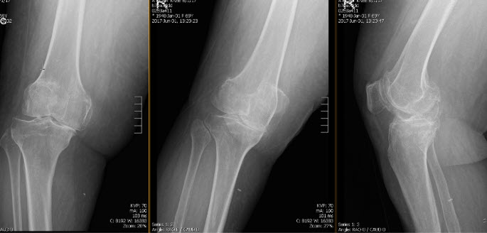 Arthroplastie totale du genou droit avec utilisation de tiges tibiales