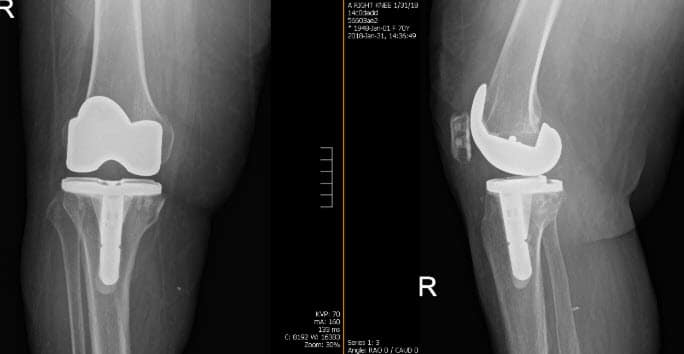 Artroplastia total de rodilla derecha