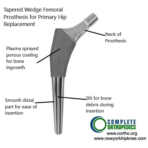 Robotic Hip Replacement Dr. Nakul Karkare Top NY Surgeon