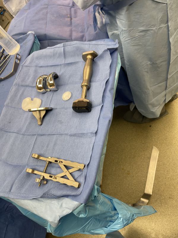 Custom knee replacement ready for implantation