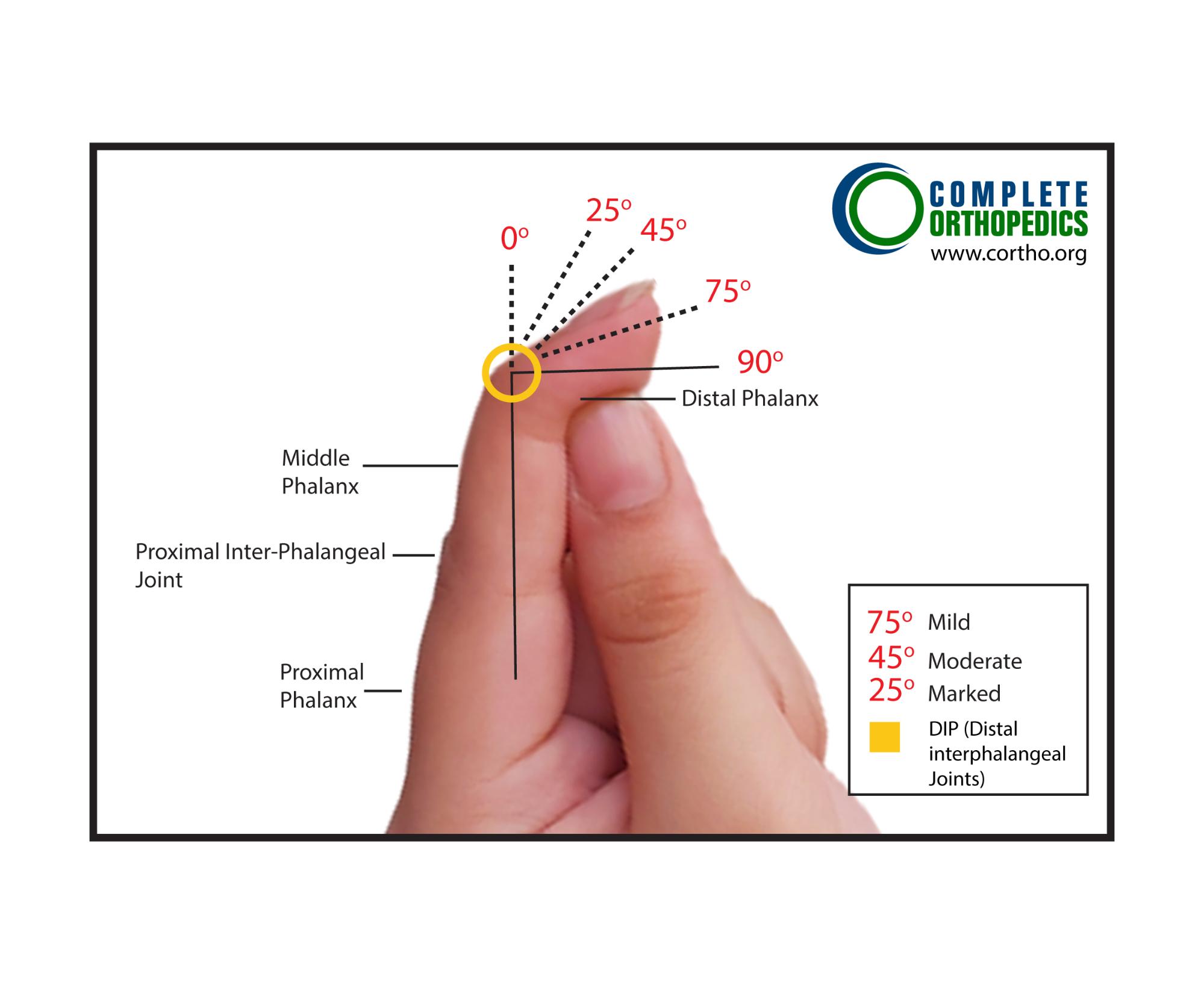 Measurement Position for Proximal Interphalangeal (PIP) Joint Measurement Position